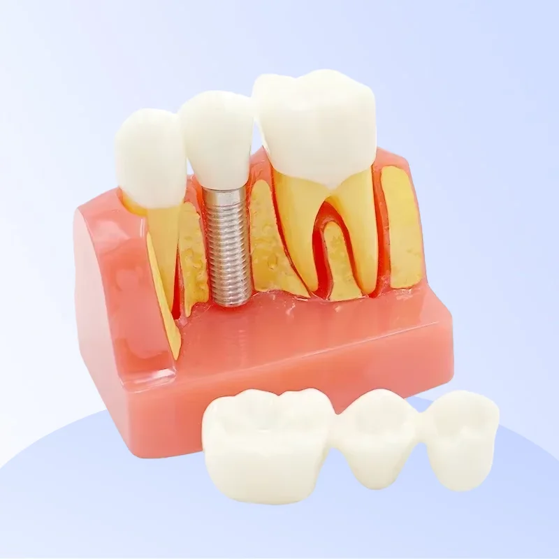 

Модель съемных зубов, 4-кратный анализ имплантатов, демонстрация коронного моста для обучения студентов