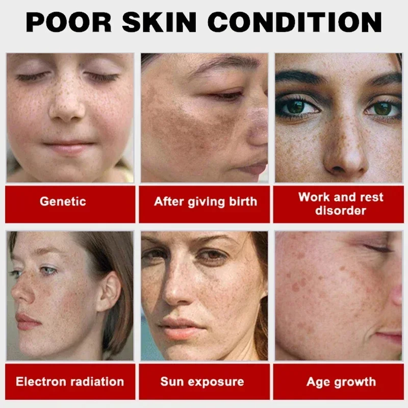 Krim pemutih menghilangkan noda kuat, mencerahkan kulit dengan cepat menghilangkan Melanin pigmentasi Melasma bintik hitam perawatan kulit Korea