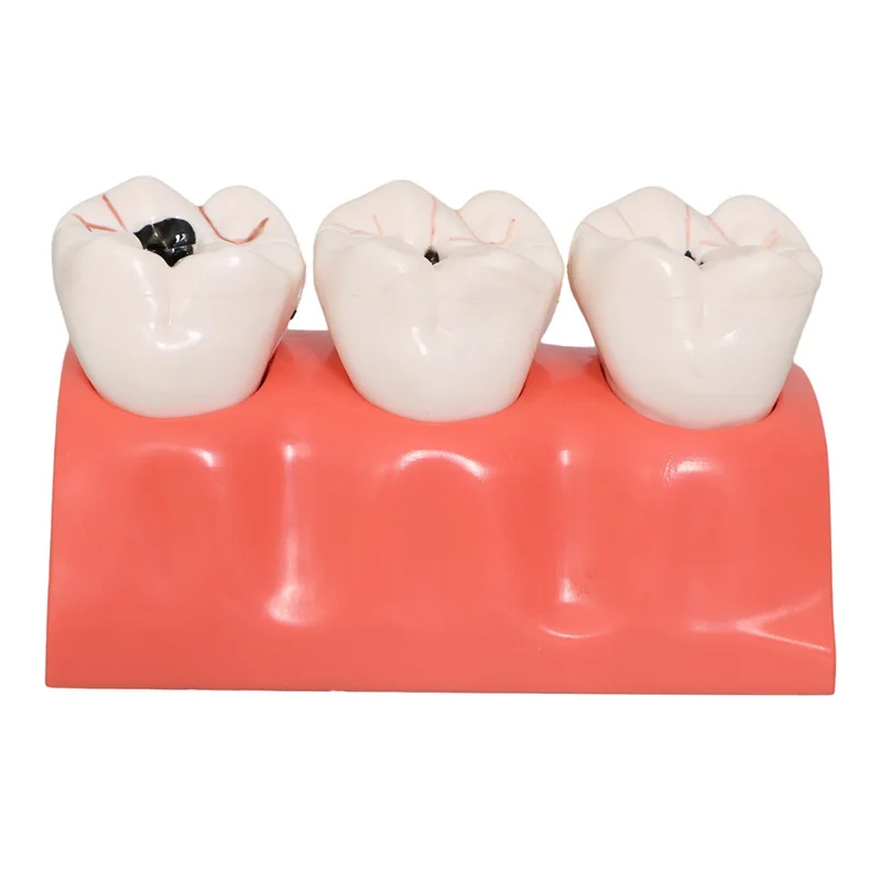 Modello di sviluppo delle carie dentali Modello dentale Modello di disintegrazione delle carie Multiplicazione quadrupla a 3 fasi