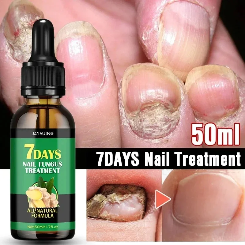 7 dias tratamento de fungos nas unhas essência óleo pé dedo do pé remoção de fungos nas unhas soro reparação onicomicosi anti infecção gel produtos de cuidados