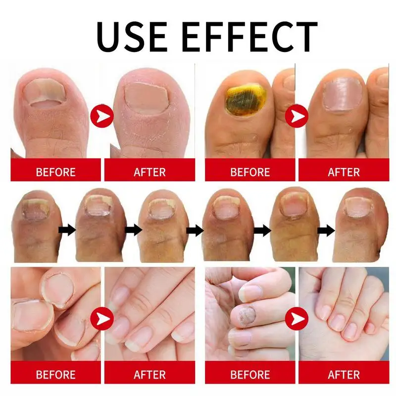 Nail Growth Oil Nail Repair Liquid For Growth Portable Nail Cuticle Conditioner Nail Strengthener Mild Nail Cuticle Oil For