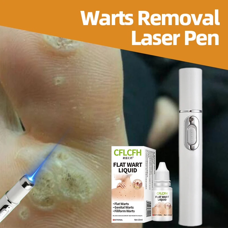 

Wart Remover Laser Pen for Men and Women Effective on Plantar Genital Common Corn Warts Skin Care Tools