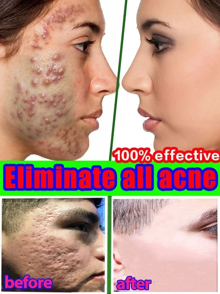 Ervas-Acne Tratamento Rosto Soro, Pimple Remover, Encolher Poros, Controle De Óleo, Cuidados Com A Pele