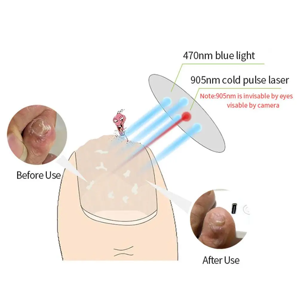 25W 905NM dispositivo per trattamenti per unghie Laser fungo del chiodo ricarica USB terapia della luce per unghie macchina per la cura dell'onicomicosi dell'unghia del piede