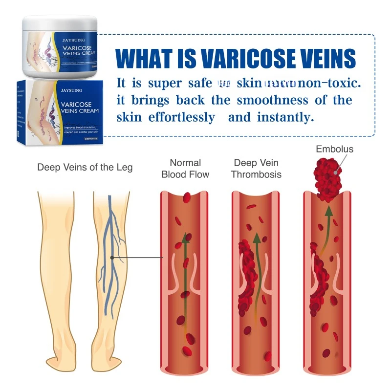 كريم إزالة الدوالي ، مرهم عشبي ، تخفيف الساق ، التهاب الأوعية الدموية ، التهاب الوريد المتوسع ، ألم العنكبوت ، علاج الانتفاخ ، 50 جم