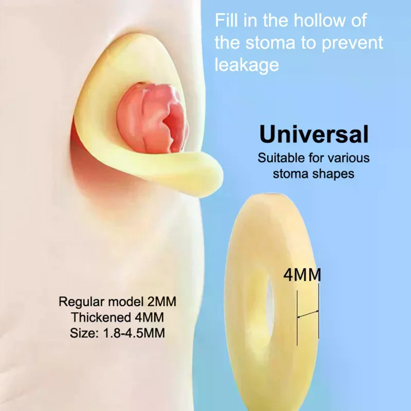 Barrier Stoma Ostomy Strips Tape Skin Supplies Strip Rings Nursing Adhesive Pressure Fixing Colostomy Leak Proof Ileostomy Pouch