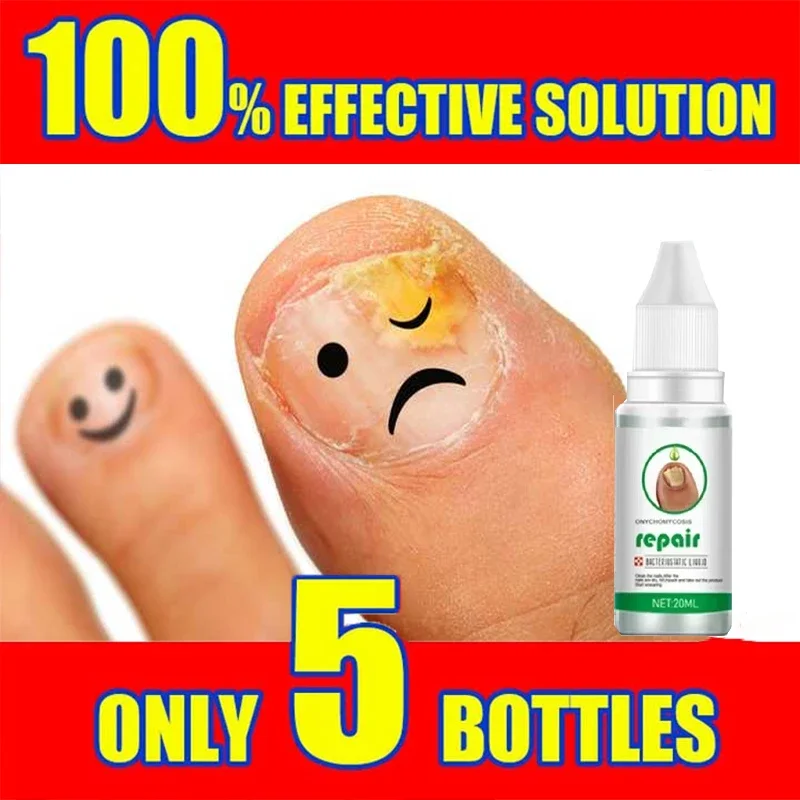 Fungal Nail Treatment Oil Foot Repair Essence Toe Nail Fungus Removal Gel Anti Infection Cream Fungal Nail Removal Paronychia