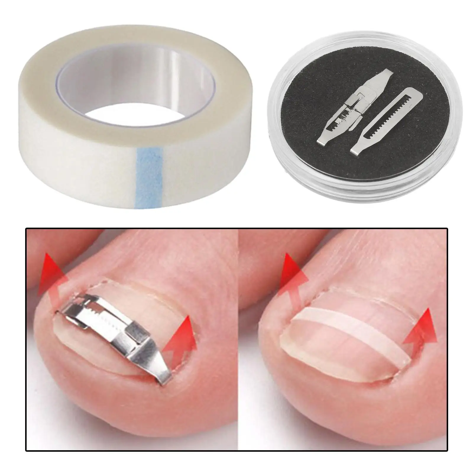 4xIngrown Toenail Treatment Ingrowing Corrector ペディキュアツール フットケアセット D