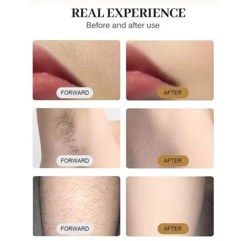 808nm Diode Laser Hair Removal Handle, Professional Ice Depilatory Beauty Machine Spare Part with 4 Replaceable Heads Nose Tip