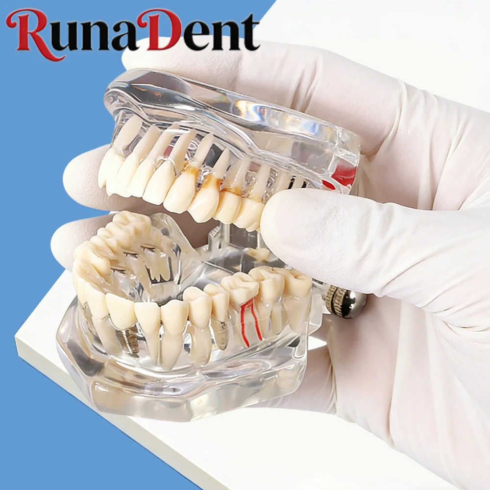 

Dental Implant Model Tooth for Dentist Training Teaching Study Tool Dental Disease Simulation Teeth Anatomy Replica