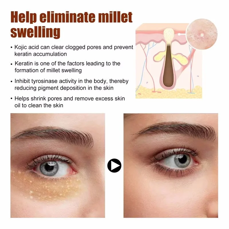 Fat Granules Remover Eye Cream Anti-Puffiness Anti Inflammatory Reduce Dark Circles Eyebags Fade Lines Moisturizing Eye Care view 6