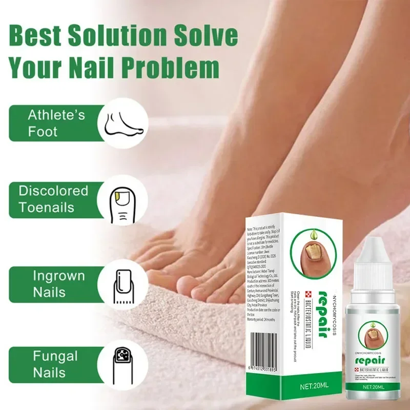 

Nail Fungus Treatment Serum Toe Fungal Repair Products Hand Foot Care Removal Gel Anti Infection Paronychia