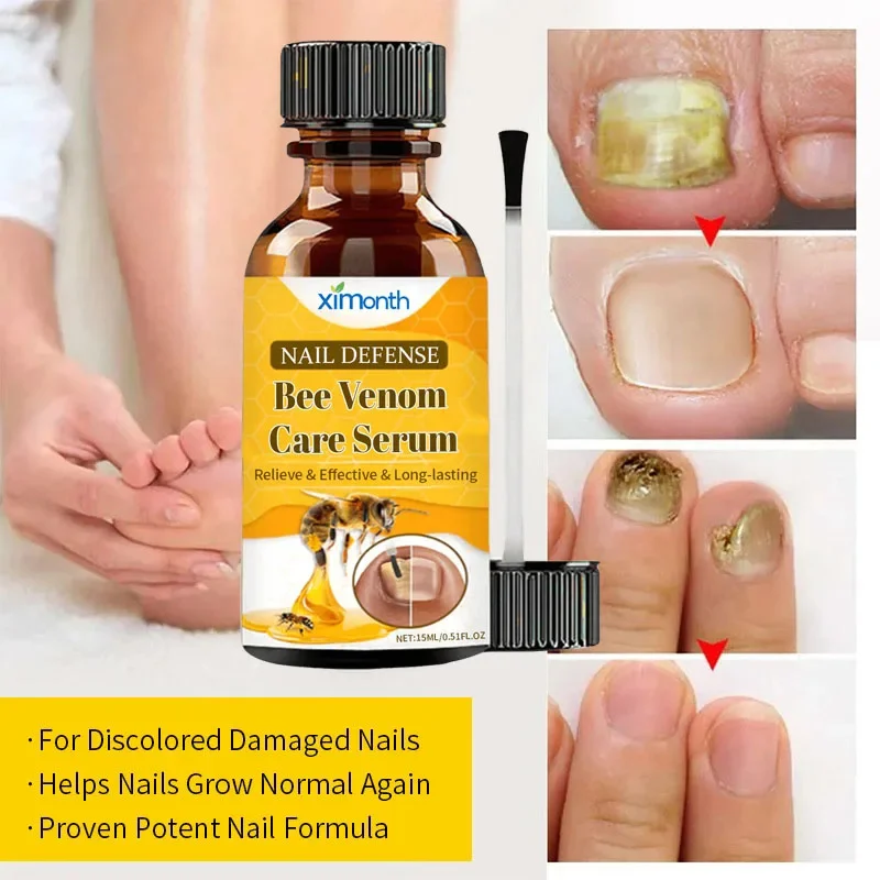 손발톱 무좀 치료 세럼 발가락 손발톱 무좀 제거 에센셜 오일 항균 손발톱진균증 손발톱 주위염 치료 관리