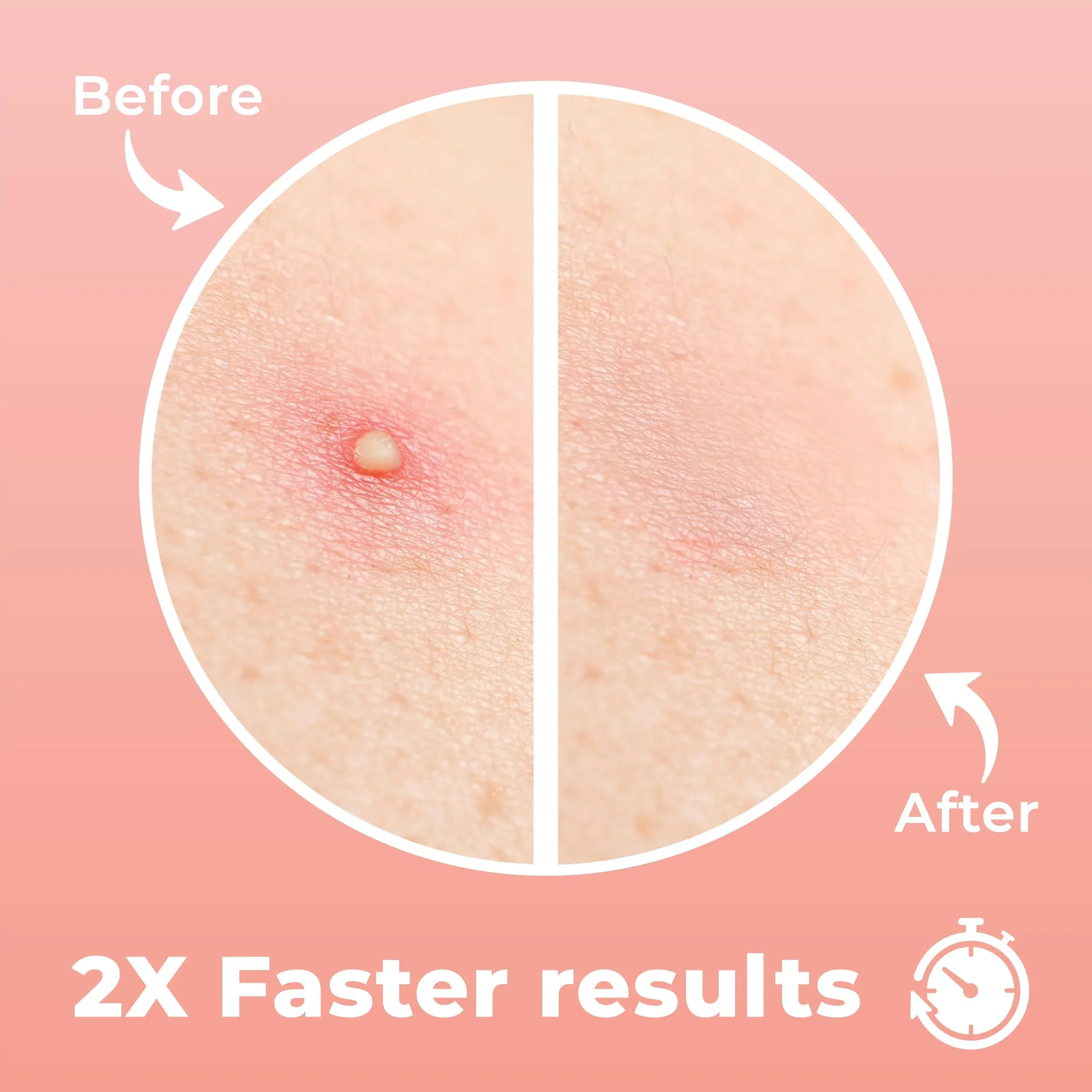 Hitworker بقع حب الشباب 24 قطعة حمض الهيالورونات الساليسيليك سريع المفعول العناية بالبشرة الكورية