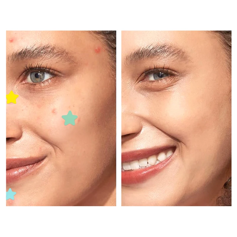 51 قطعة حب الشباب التصحيح جهاز العناية بالوجه تتلاشى العيوب بثرة علامات مغلقة حب الشباب العيوب غطاء حب الشباب بثرة رقعة إصلاح الإطارات