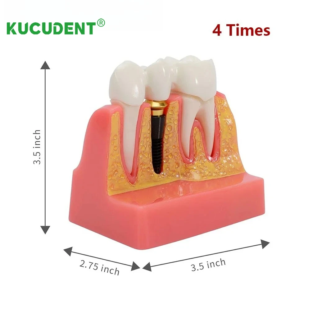 4/6 Times Dental Implant Teeth Model Caries Tooth Model  Analysis Crown Bridge Demonstration Removable Training Teaching Models