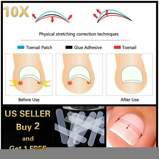 

10 шт., наклейка для коррекции вросших ногтей, инструмент для педикюра, корректор для ногтей на ногах