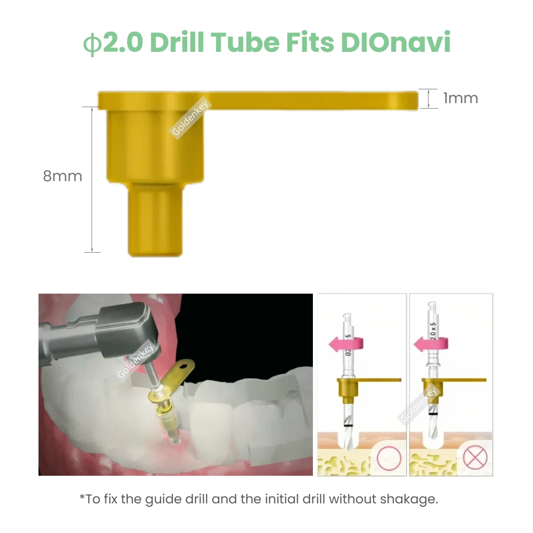 

φ2.0 Drill Tube Fits DIOnavi 8mm Dental Digital Drill Tube Guider UDTE 20 Com with 5.3 Dio Guide Sleeves