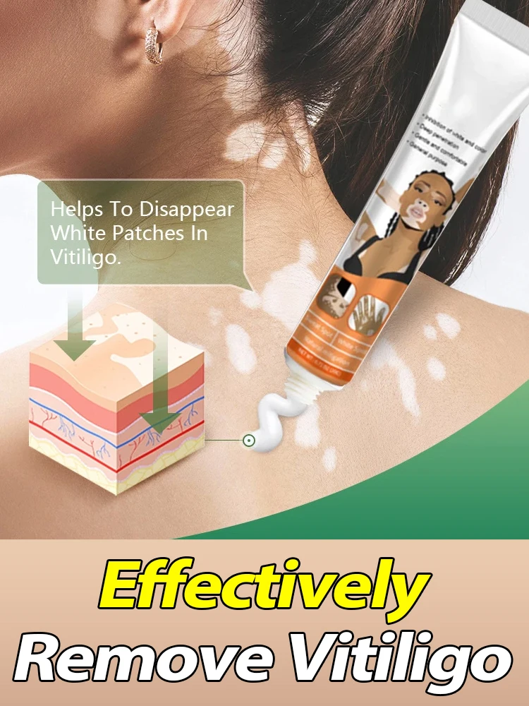 Effectively Remove Vitiligo Ointment Ringworm White Spot Removal Skin Vitiligo Eliminate Vitiligo Skin Care