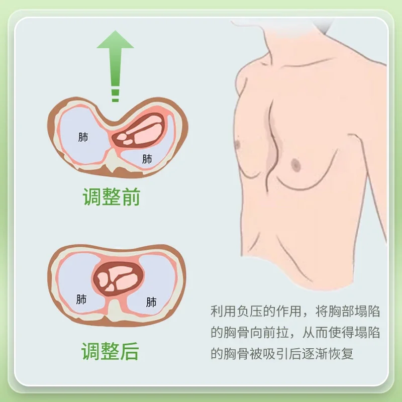 Funnel chest, negative suction cup, children's orthotics, children's sternal fracture, depression, flat chest correctio