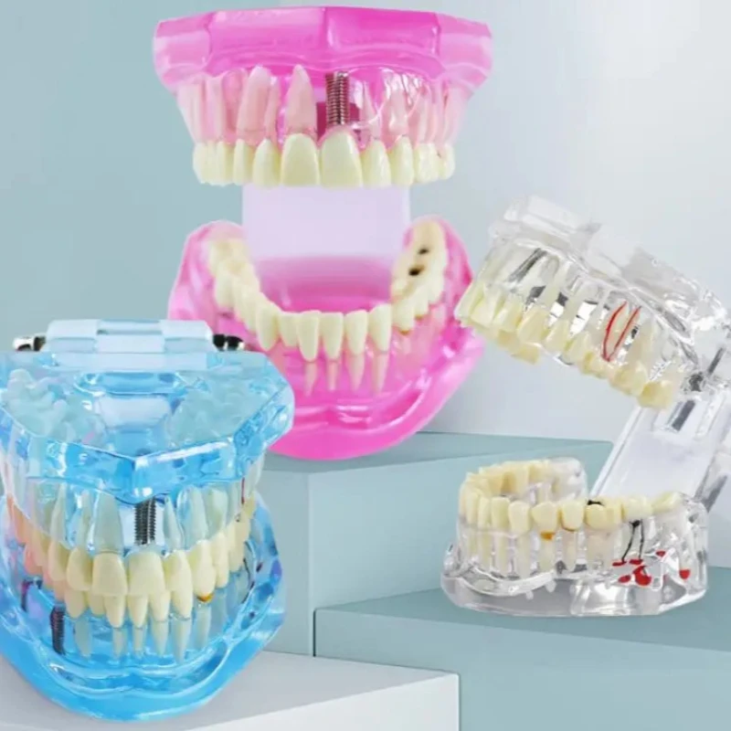 2Pcs Dental Models Removable And Restorable Models Of Diseased Teeth For Teaching And Researching Medical And Dental Diseases