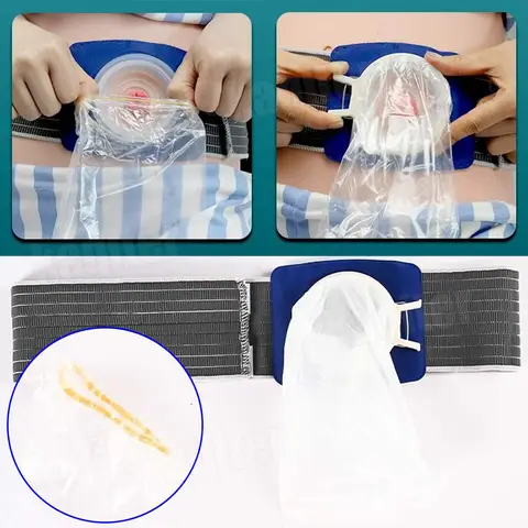 Sztuczna stomia analna, osłona na woreczki do stomii jelitowej, pas stomiologiczny, woreczek do stomii drenażowej, woreczek do urostomii po ileostomii z woreczkiem jednorazowym.