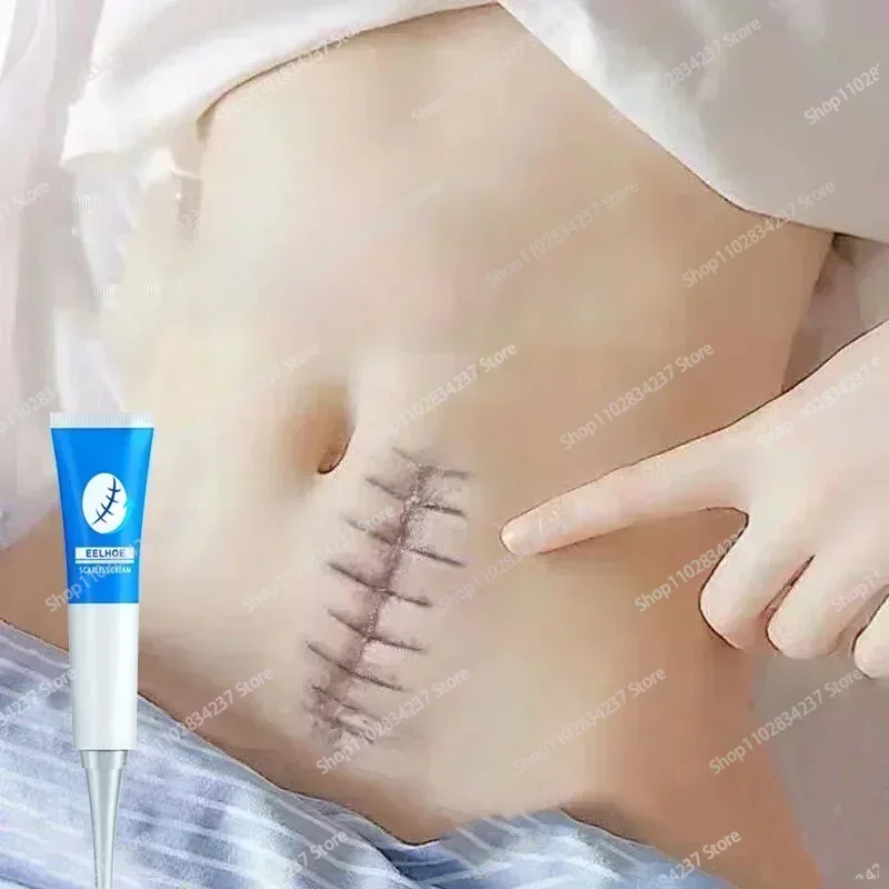 Repair Burn Surgical Scars Stretch Marks Promote Cell Regeneration Repair Treatment Body Skin Care Product 2024