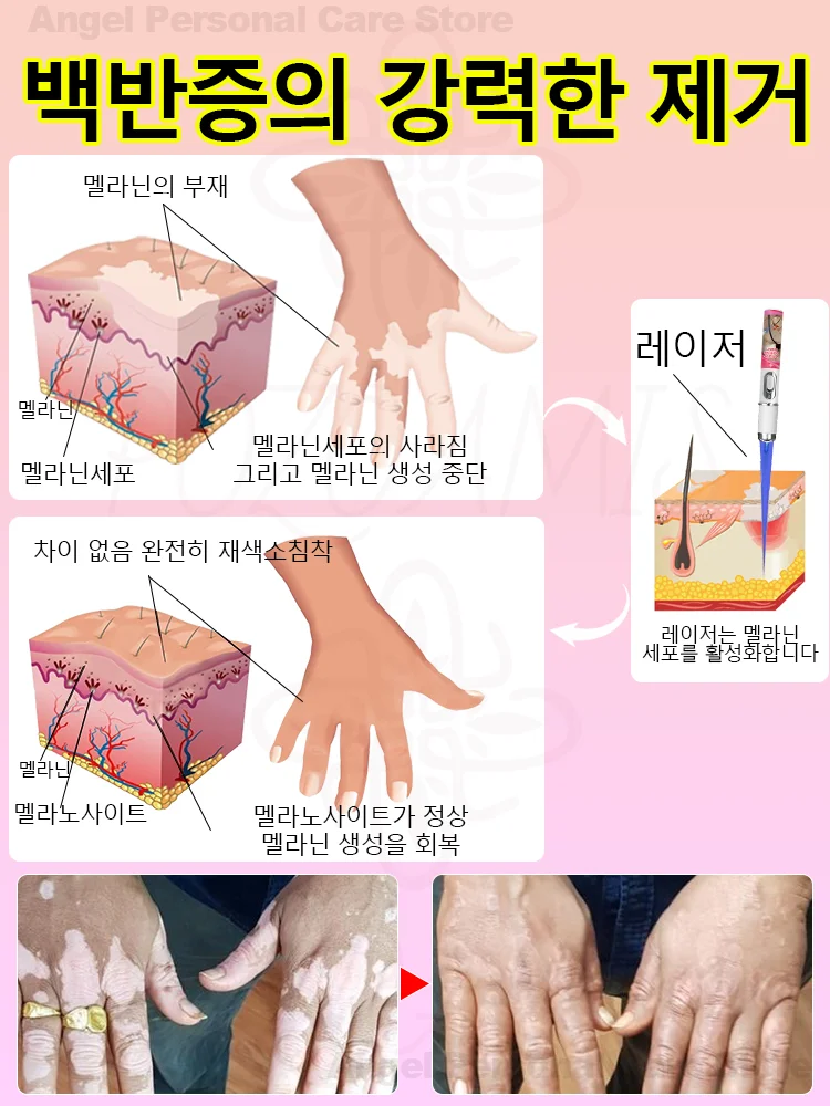 백반증 레이저 치료