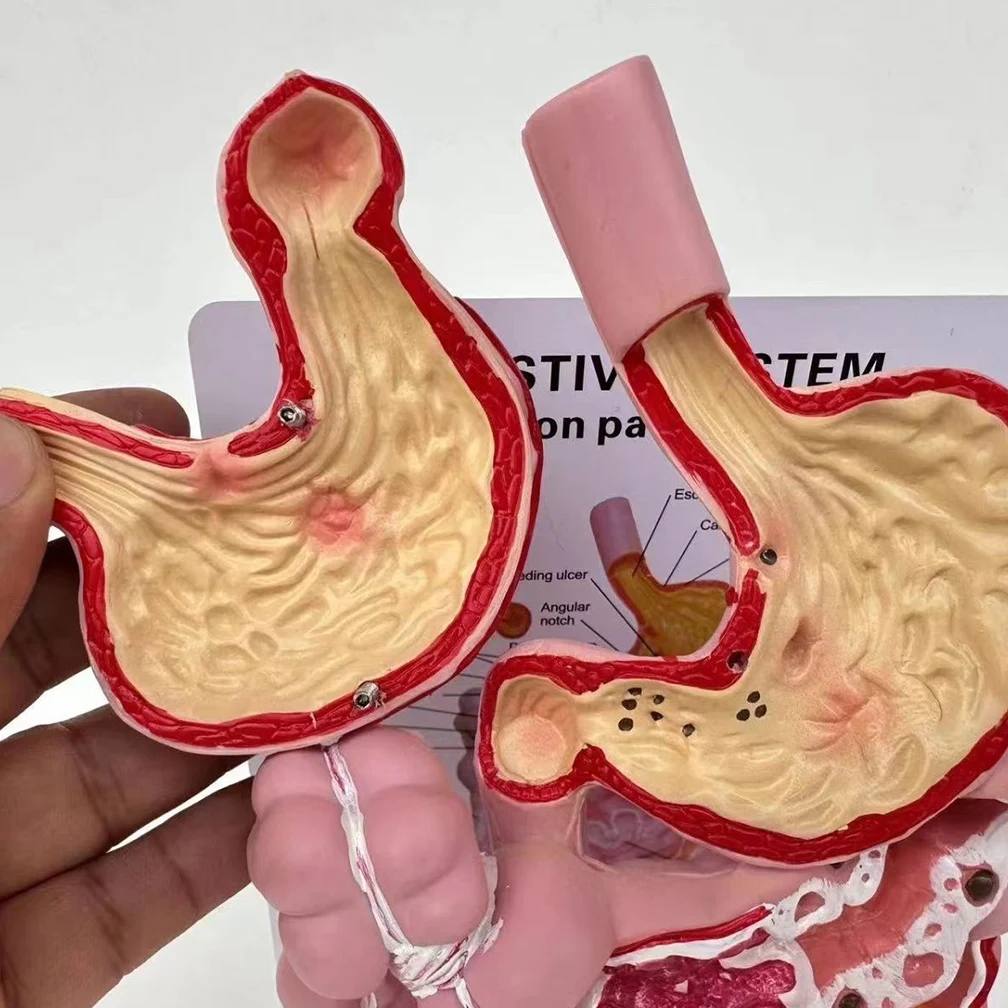 Adult Large Intestinal Pathology Model Human Digestive System Anatomy Model Medical Teaching Tools Gastrointestinal Lesions