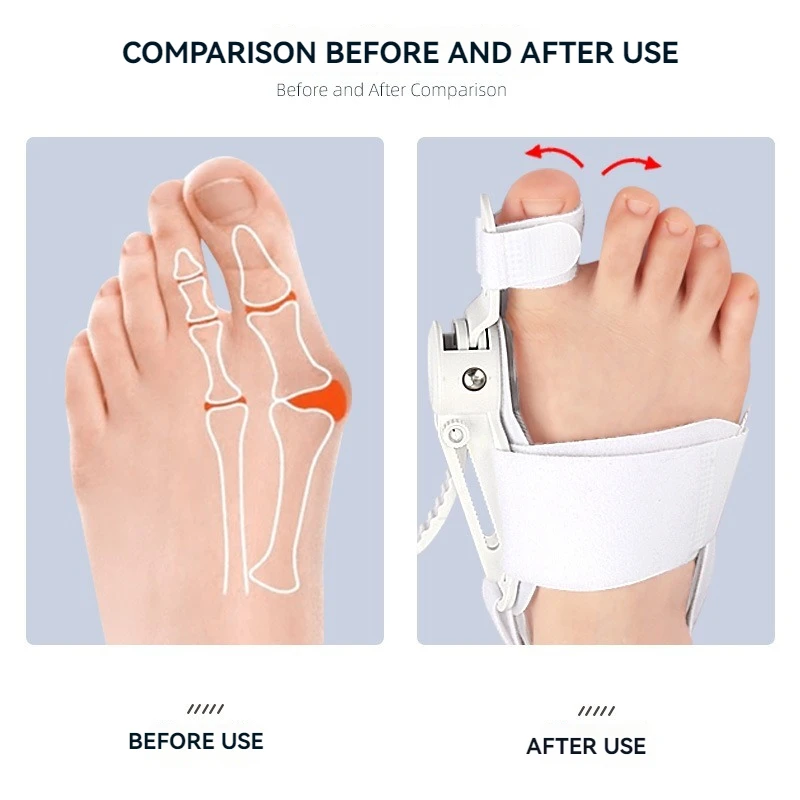 Adjustable Big Toe Alignment Splint | Overlapping Toe Corrector Device