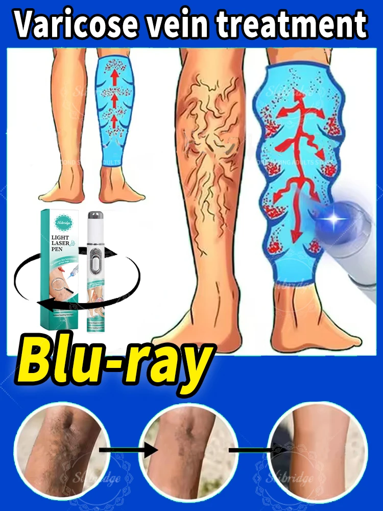 

Effectively relieves dilated vasculitis in the legs and eliminates varicose veins Suitable for all age