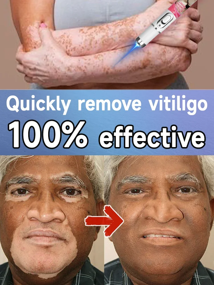 Effective treatment for vitiligo