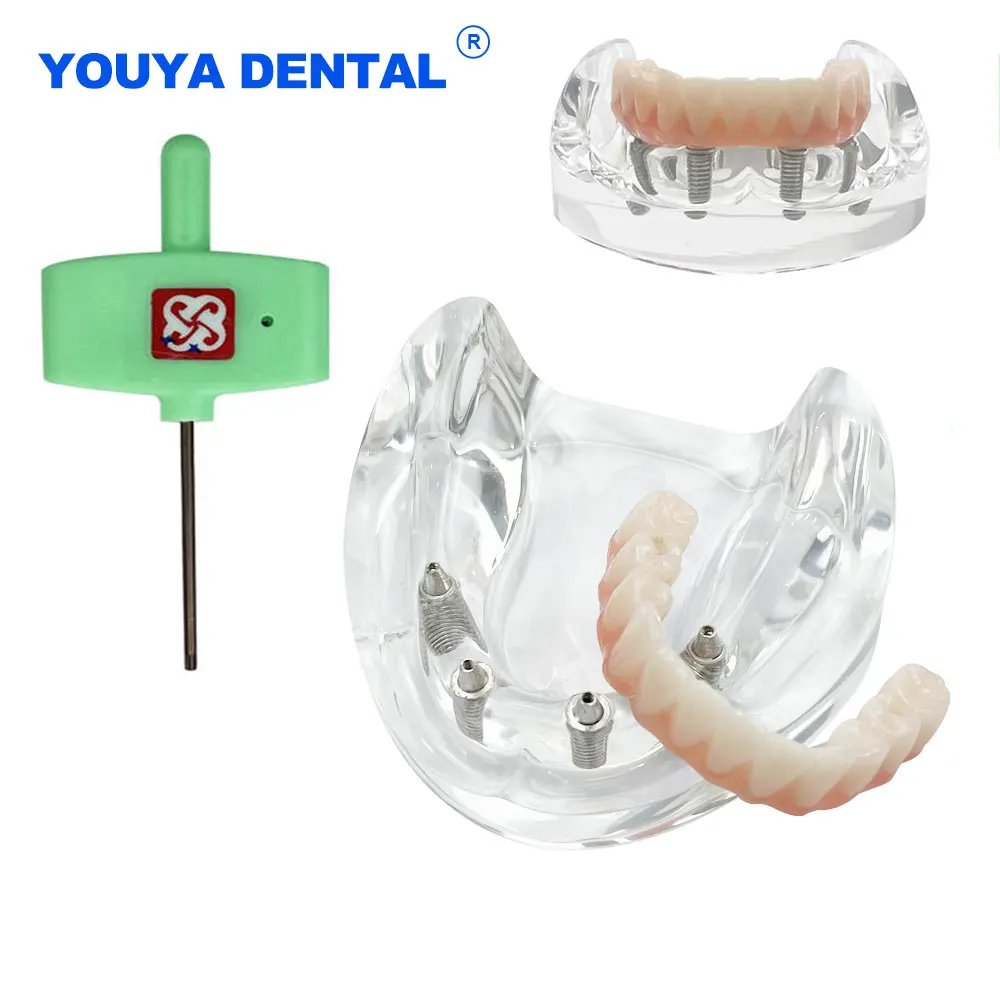 Transparent Dental Implant Teeth Model Lower Jaw Overdenture Inferior Demo 4 Implants Screws Demo Overdenture Model