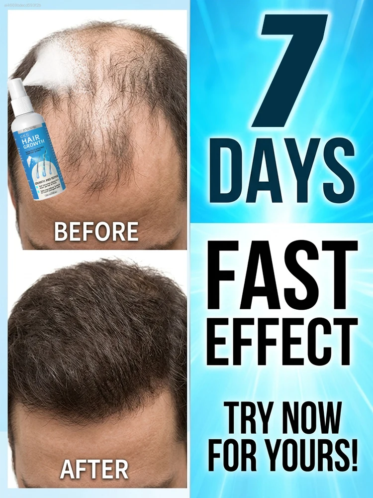 

Sᴛɪʟʟ ᴛʀᴏᴜʙʟᴇᴅ ʙʏ ʙᴀʟᴅɴᴇss Gᴇᴛ ʏᴏᴜʀ ᴛʜɪᴄᴋ, ʙᴇᴀᴜᴛɪғᴜʟ ʜᴀɪʀ ʙᴀᴄᴋ ɪɴ 7 ᴅᴀʏs!