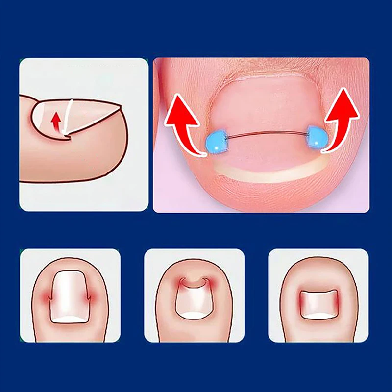 Ensemble de fils bleus pour ongles incarnés, traitement professionnel des pieds, récupération de gélatine, pédicure, outil de lissage