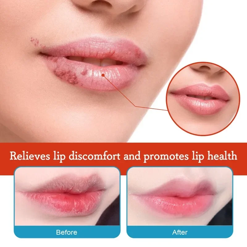 Cold Sores Lip Cheilitis Treatment Cream Herpes Antibacterials Ointment Chapped exfoliating fade Lip line moisturizing care balm