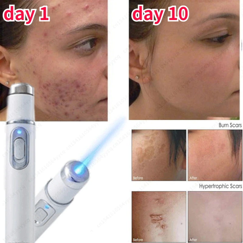 For Dropshipping Acne Laser Pen Portable Wrinkle Removal Machine Durable Soft Scar Remover Device Blue Light Therapy Pen Massage