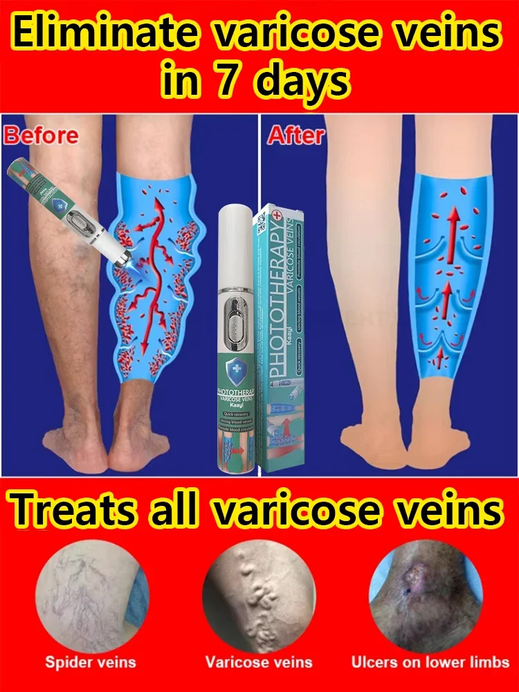 

for Sensitive and Couperose Skin Varicose vein laser pointer Blue Light Laser