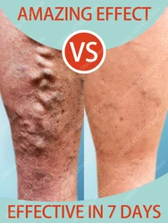 Varicose Veins Ointment Removal Cream Treatment