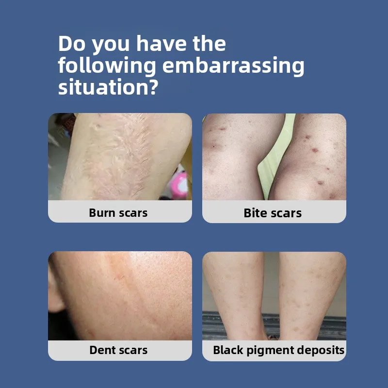 

Крем для восстановления шрамов — исчезает хирургию, растяжку, ожогов и шрамы от прыщей. Премисно уменьшают следы для гладкой кожи.