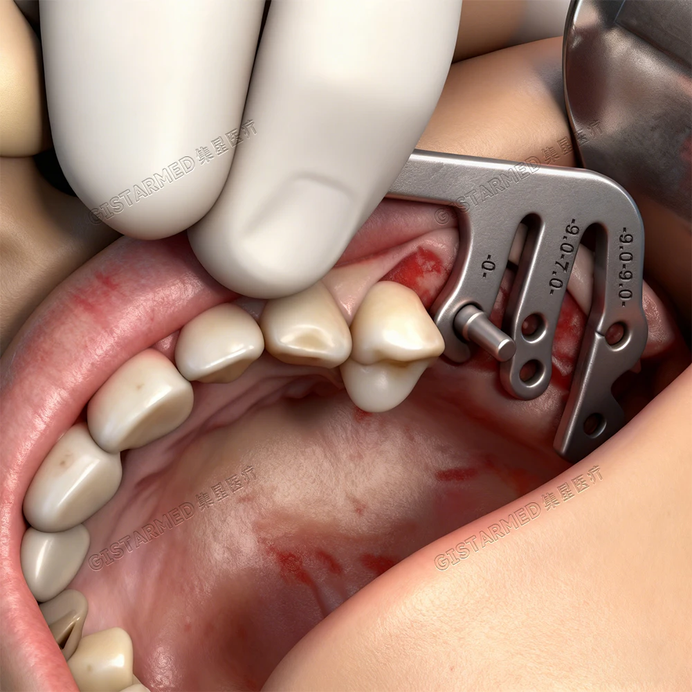 1 مجموعة زراعة الأسنان دليل حاكم مجموعة طبيب الأسنان زراعة محدد الحفر تحديد المواقع دليل جراحة أداة زاوية أدوات