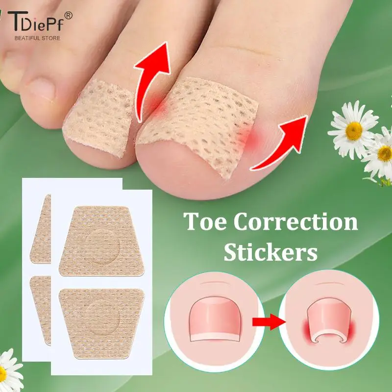陥入爪足指補正ステッカーネイルアートフットパッチ足ケア爪周囲炎治療回復ペディキュアフットツール