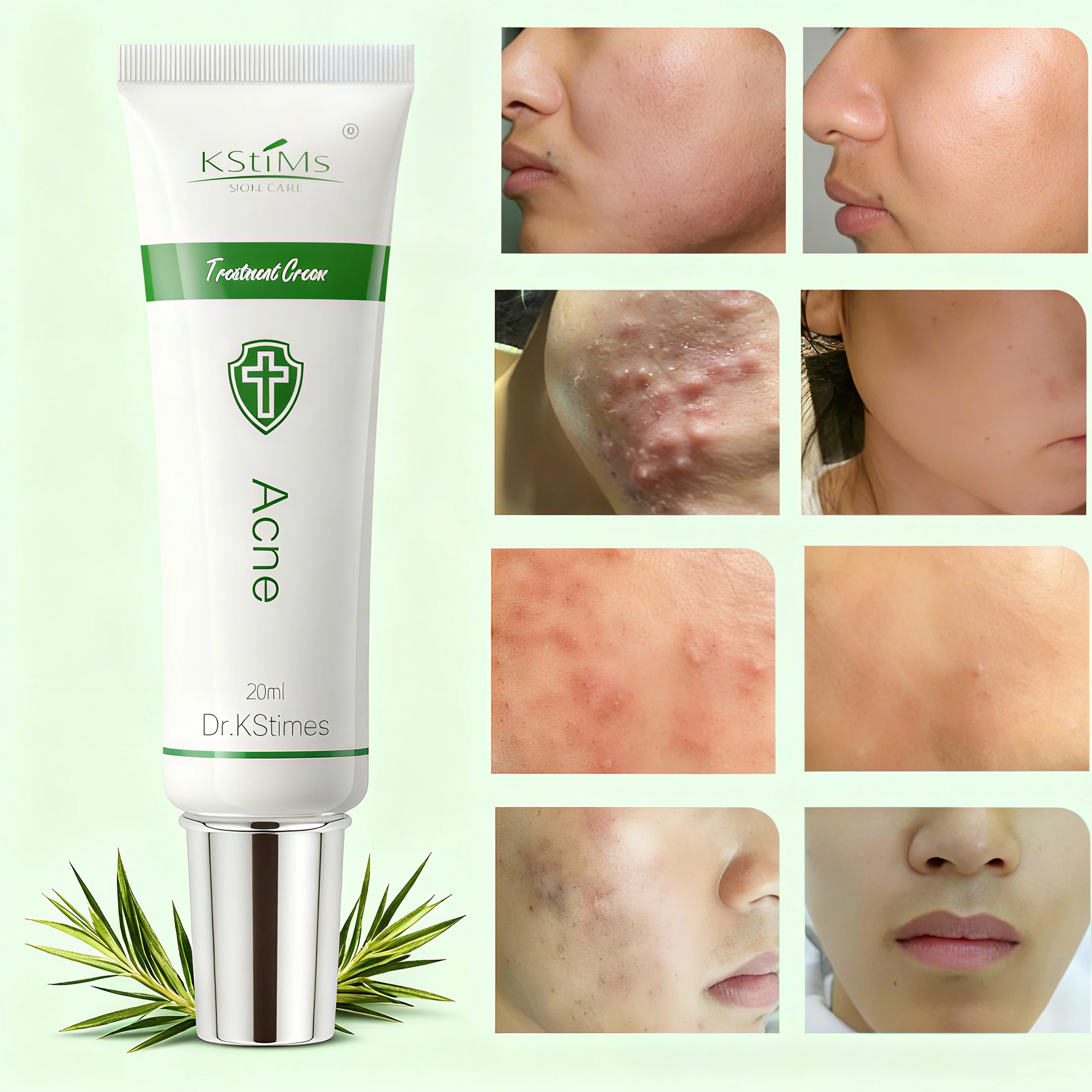 

Acne Treatment Face Cream Acne Spot Treatment for Dots Tea Tree Oil Natural Cystic Acne Treatment Scar Cream Pimple Remover