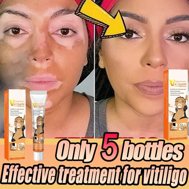 ⁿⁱᶜᵉ Remove Ringworm White Spot Removal Skin Vitiligo