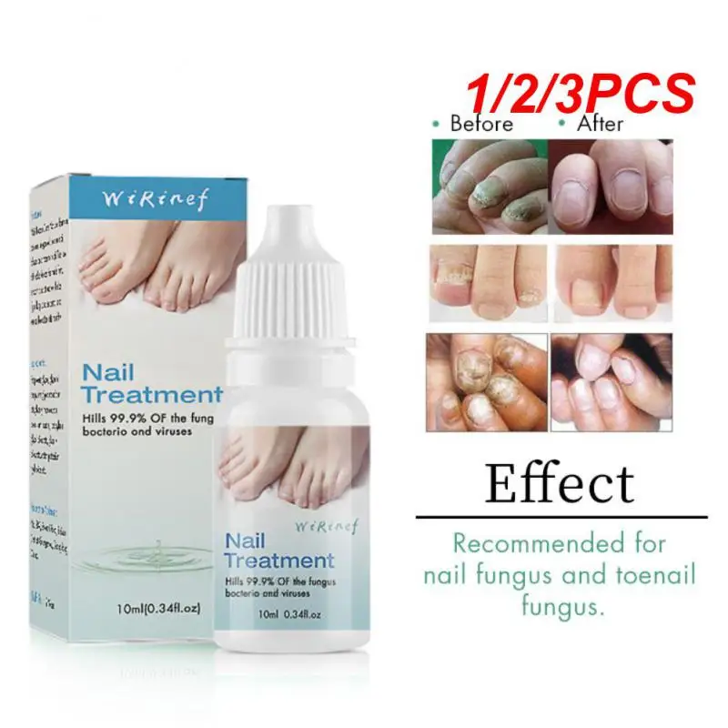 1/2/3PCS Paronychia Cream Safe And Natural Advanced Fast Acting Paronychia Cream Nail Fungus Cure Popular Nail Fungus