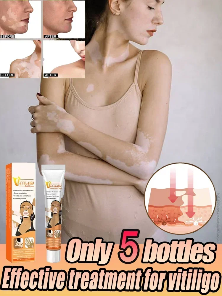Crema hidratante para manchas blancas, reduce las manchas blancas, cuidado de la piel, cuidado de la vitíligo, crema hidratante para el cuidado de la vitíligo, reduce las manchas blancas