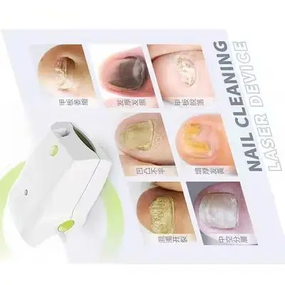 

Portable Toenail Fungus Removal Laser Device 7 Min/Day Fast Treatment No Side Effect