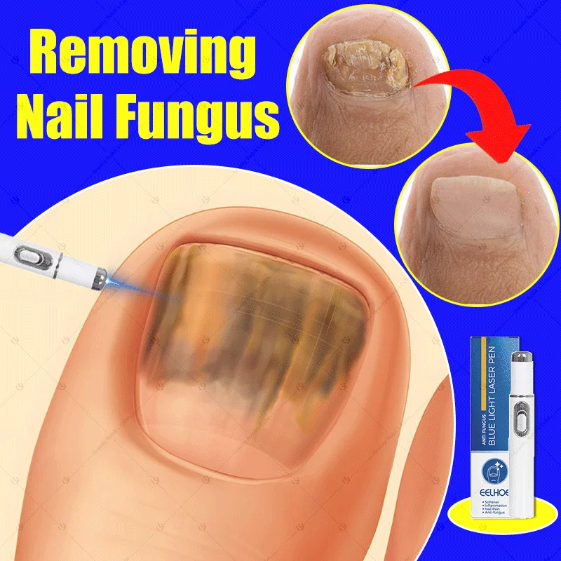 

Laser pen，Let you have a pair of brand new toenails.