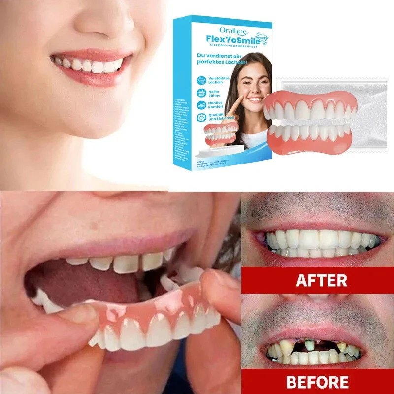 SK Temporary Snap-On Veneers — Full Upper Lower, Custom Comfort Fit ck848