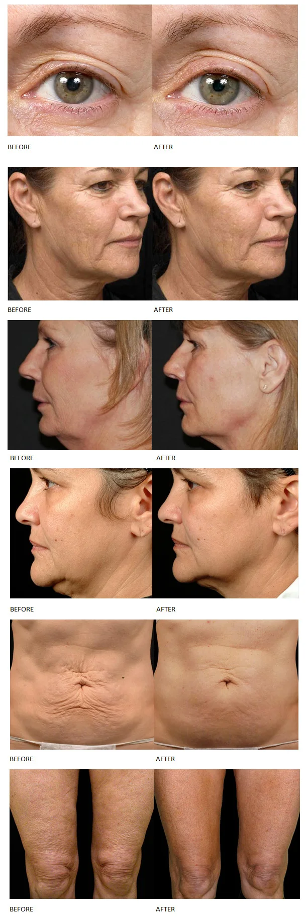Ultra 360 Hautstraffung, Kollagenpistole, Cellulite-Reduktion, 2-in-1, unipolare Straffung der Haut, Körper, Abnehmen, Facelifting, Schönheitsmaschine – Detail 13